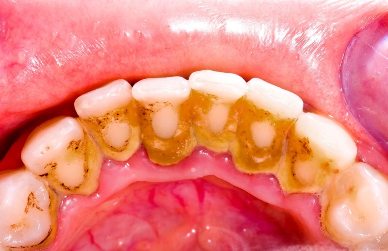 Cao răng tích tụ – nguyên nhân chính gây viêm nha chu