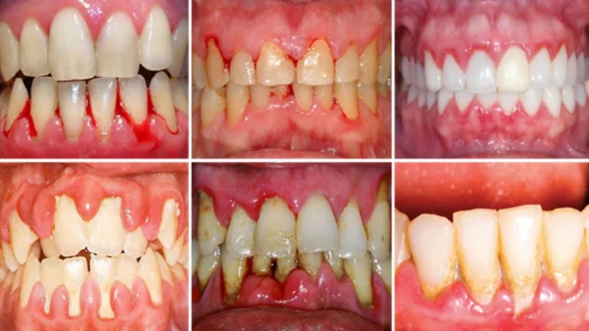 So sánh nướu khỏe mạnh, viêm lợi và viêm nha chu