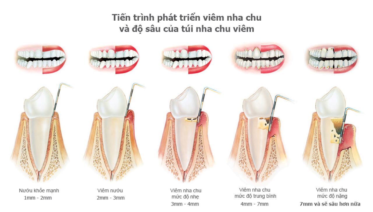 4 giai đoạn phát triển của viêm nha chu
