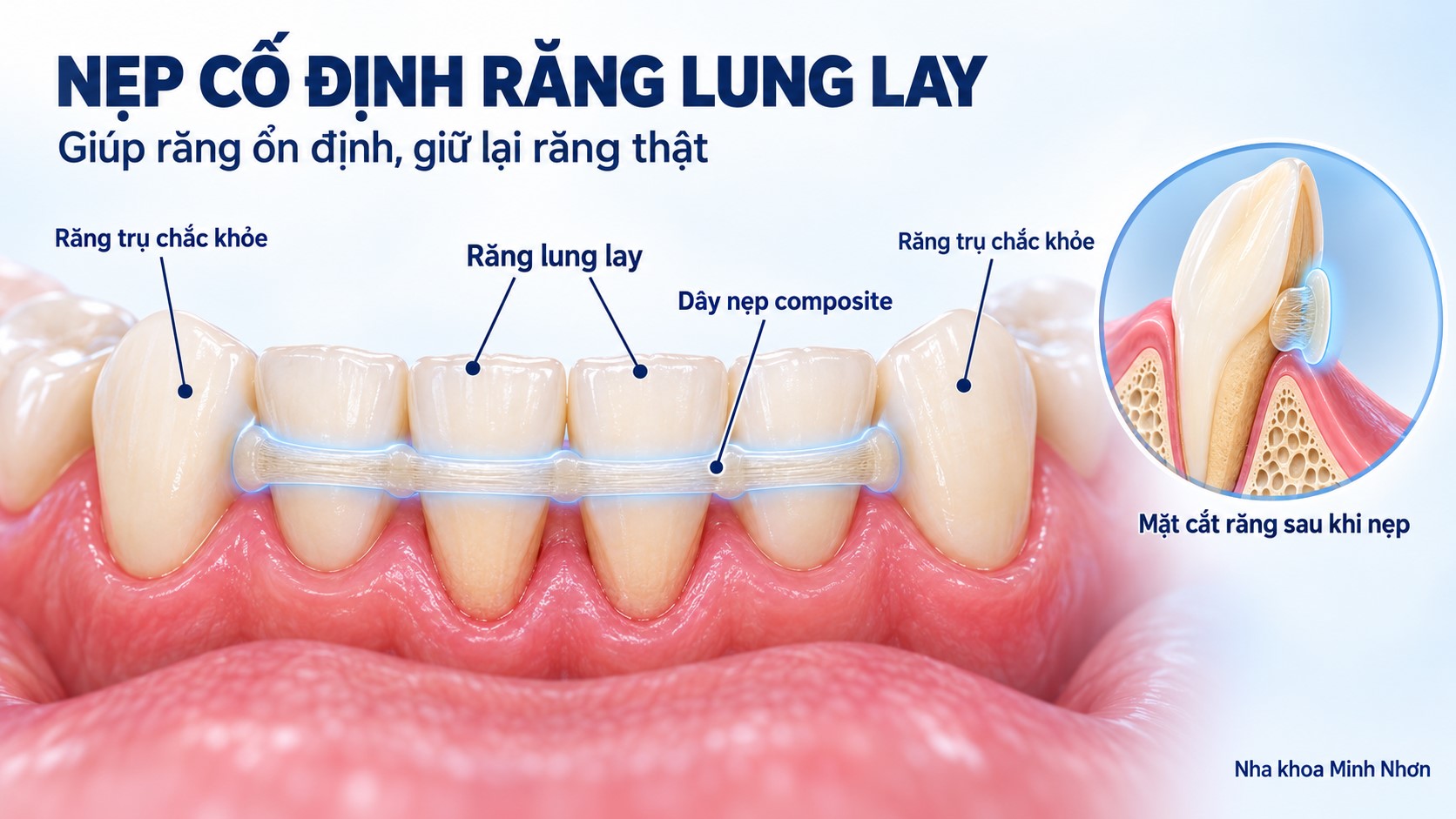 Nẹp cố định răng lung lay giúp răng ổn định