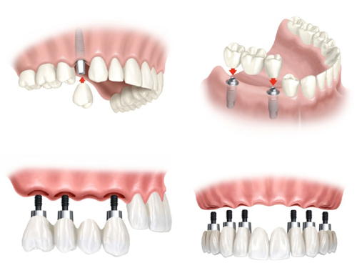 Bị mất nhiều răng thì vẫn có thể thực hiện cấy ghép Implant