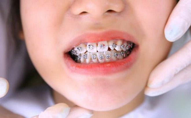 Liên hệ nha khoa Phước An để được tư vấn chi tiết vấn đề niềng răng cho con.