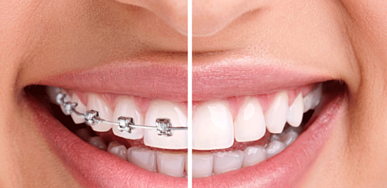 7 lưu ý khi niềng răng mà nhất định bạn cần phải biết