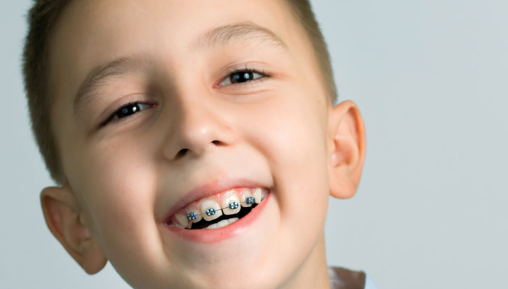 Độ tuổi từ 12-16 được đánh giá như là giai đoạn niềng răng tốt nhất.