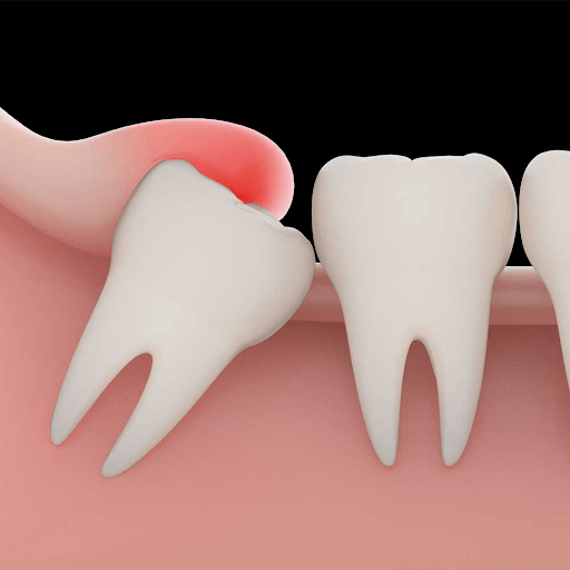 Răng khôn khi mọc cũng có thể làm nướu bị đỏ và sưng to