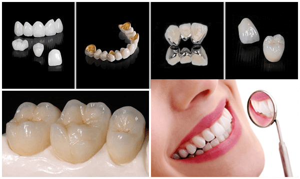  Lựa chọn chất liệu răng là một trong những kinh nghiệm bọc răng sứ quan trọng