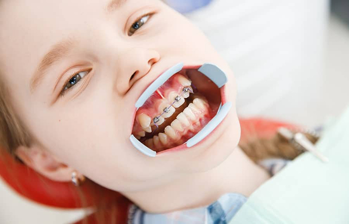Niềng răng cho trẻ từ sớm sẽ giúp tiết kiệm thời gian và chi phí