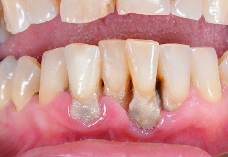 Không nên thực hiện phương pháp niềng răng khi bị viêm nha chu quá nặng