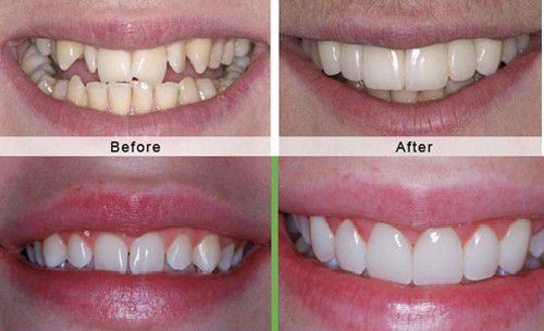 Sử dụng phương pháp bọc sứ cho trường hợp răng khấp khểnh và lệch lạc nhẹ