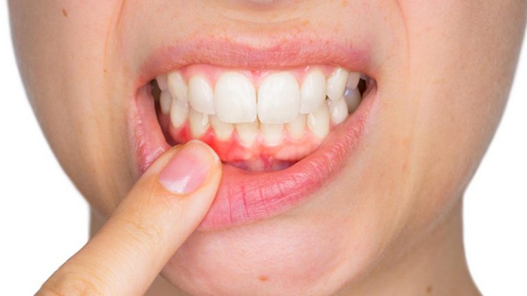 Bệnh lý răng miệng như viêm lợi sẽ dần trở nên nguy hiểm theo thời gian nếu không điều trị kịp thời.