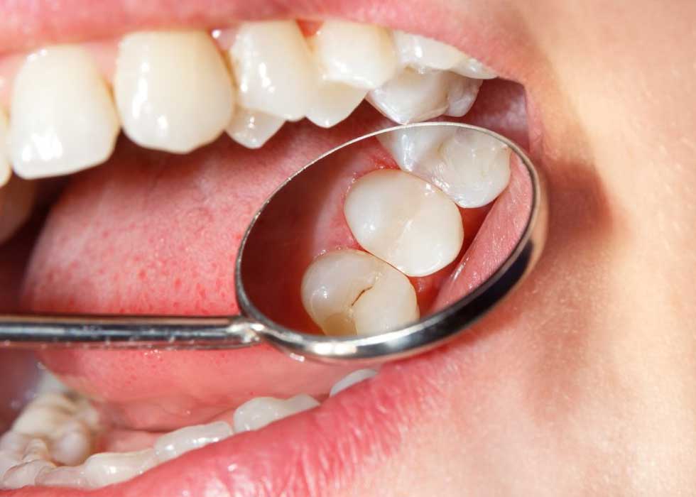 Trám răng là phương pháp chủ yếu dành cho những răng sứt, mẻ có phạm vi kích thước nhỏ hơn 2mm