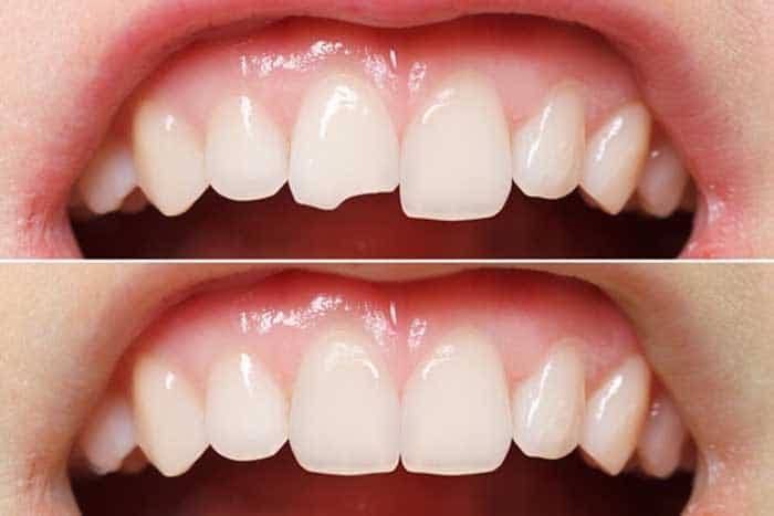 Bọc sứ còn giúp cho hàm răng trở nên trắng sáng và đều màu hơn.