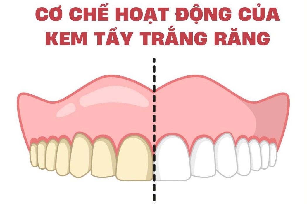 tẩy trắng răng
