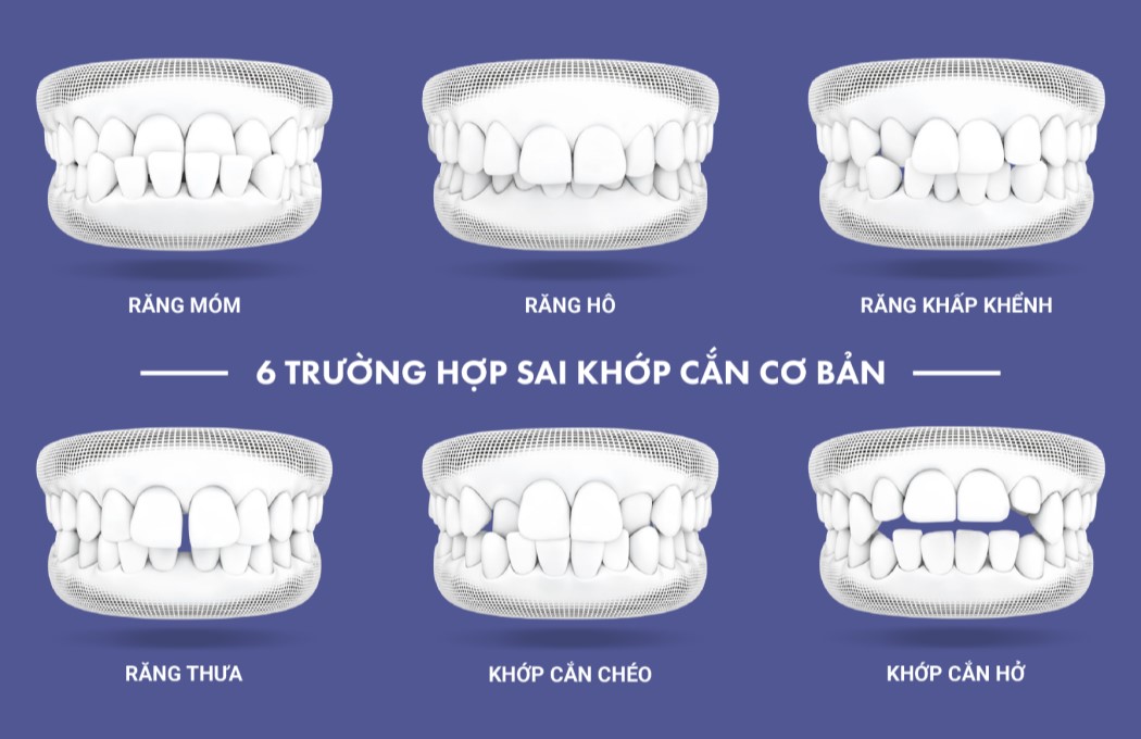 niềng răng tại phú yên